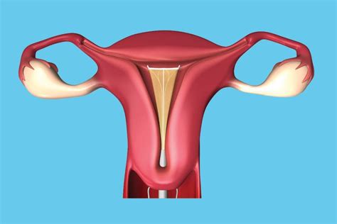 Ablatie endometriala